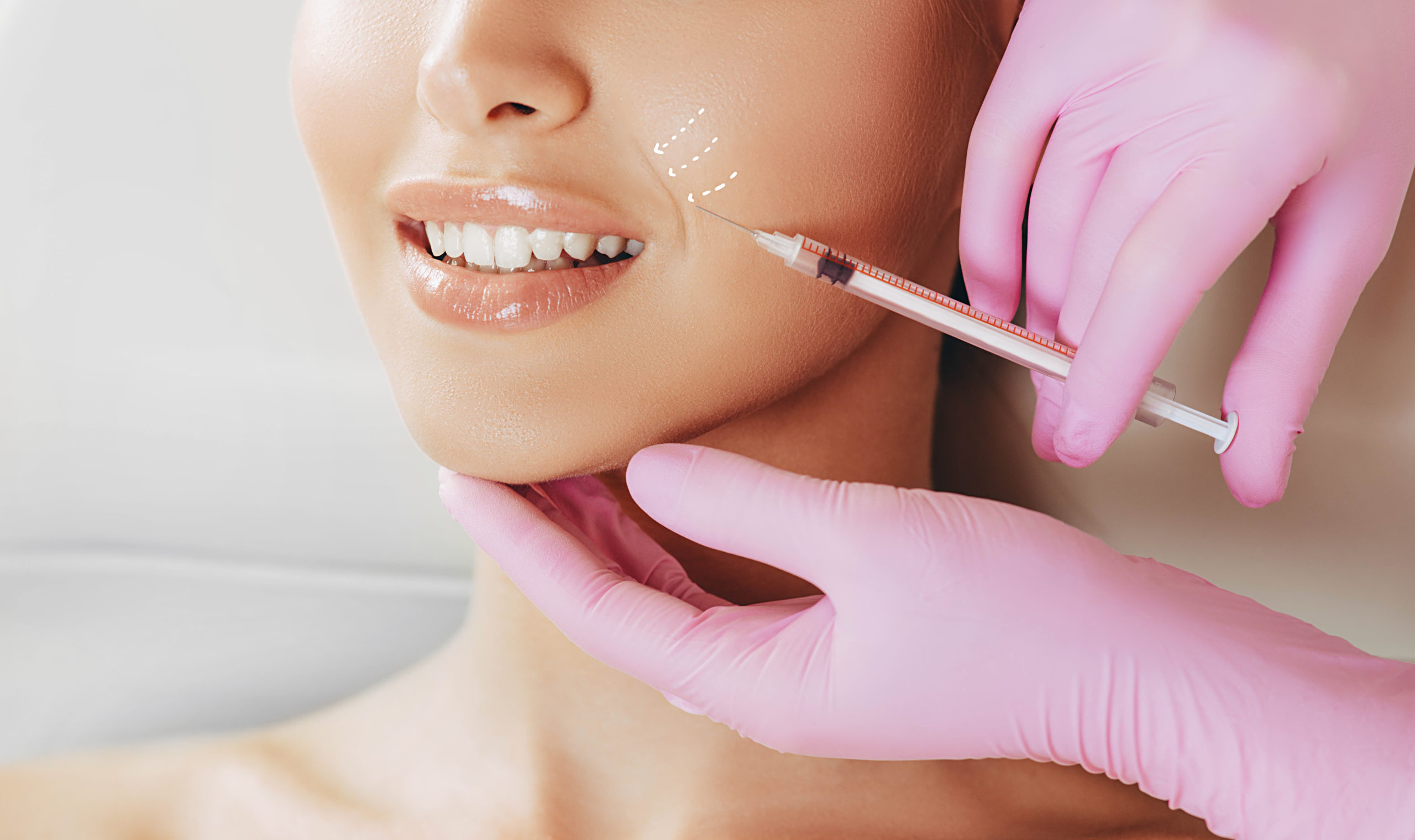 Juvederm Injection