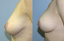 Breast Lift Only