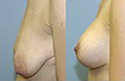 Breast Lift and Implant