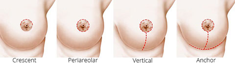 Insurance Breast Reduction - Augusta Plastic Surgery