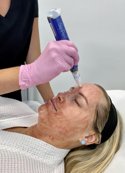 SkinPen Microneedling