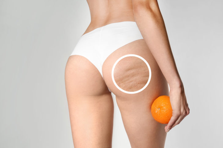 Young woman with orange on light background. Problem of cellulite