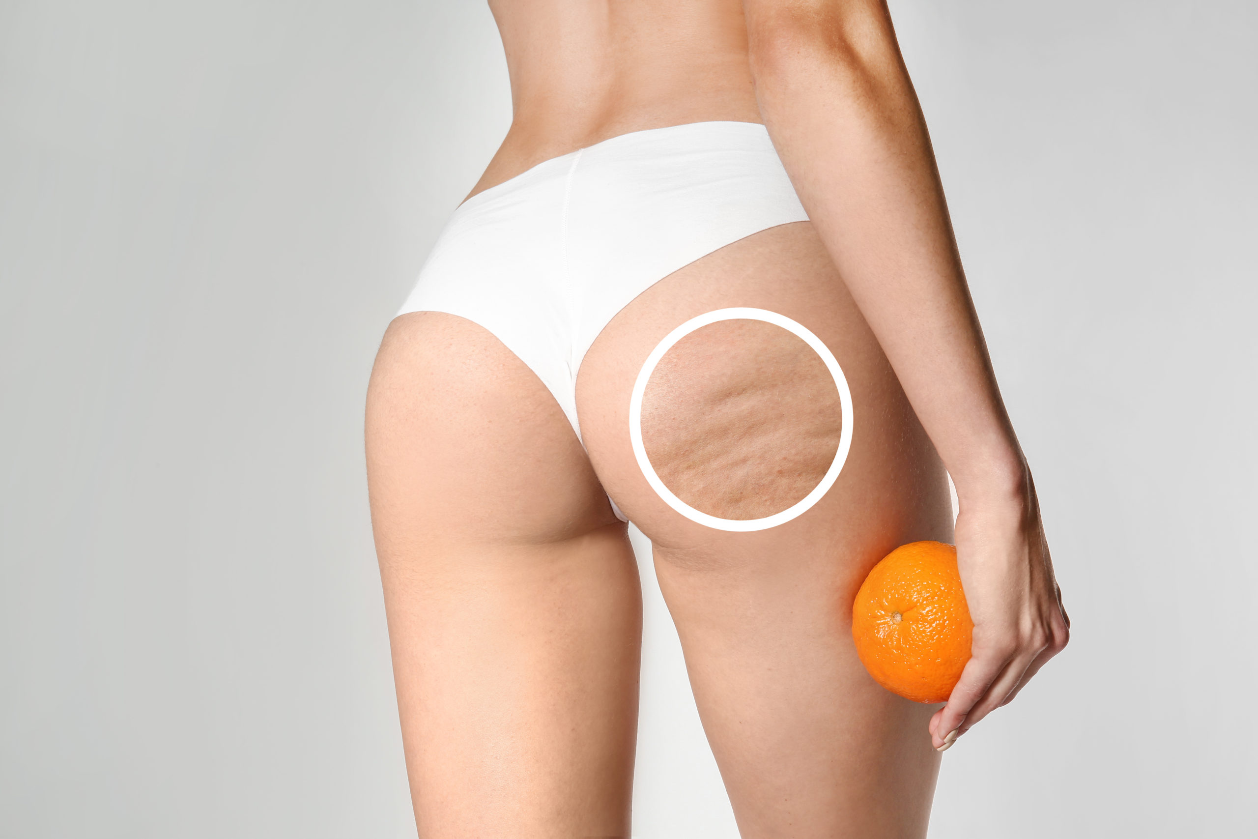 3 Easy Facts About How To Get Rid Of Cellulite (Cellulite Treatment Methods) Described thumbnail