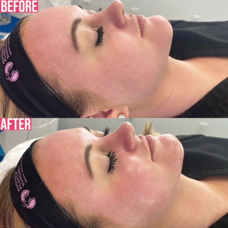 hydrafacial results before and immediately after