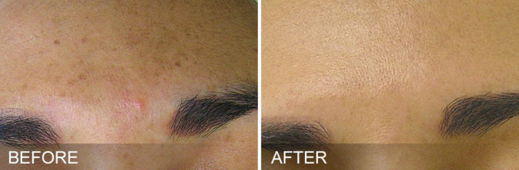 before and after results from HydraFacial